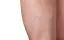 Spider Veins-placeholder